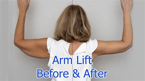 Arm Lift in Las Vegas & Henderson, NV .